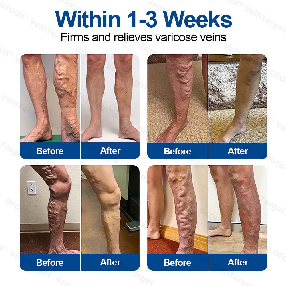🇨🇦🩹🦵✅GFOUK® EKlinisk Microneedle Patch (with Diosmin & Hesperidin) is an advanced plant-based formulation specially developed to target spider veins and varicose veins, while also helping to relieve the feeling of heavy and tired legs.-K2