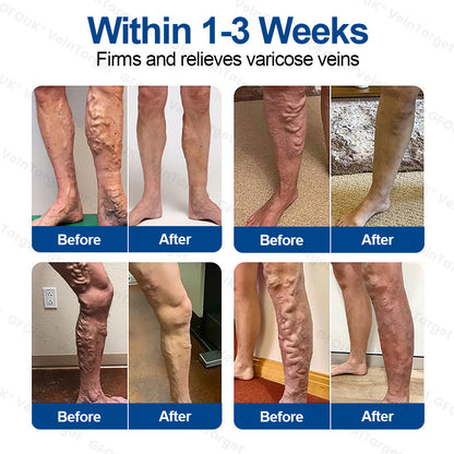 🇨🇦🩹🦵✅GFOUK® EKlinisk Microneedle Patch (with Diosmin & Hesperidin) is an advanced plant-based formulation specially developed to target spider veins and varicose veins, while also helping to relieve the feeling of heavy and tired legs.-K2