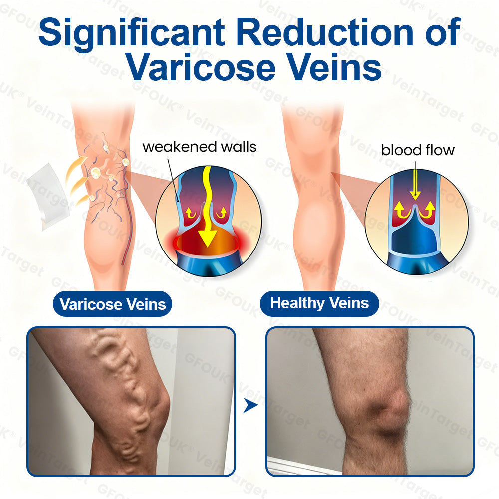 🇨🇦🩹🦵✅GFOUK® EKlinisk Microneedle Patch (with Diosmin & Hesperidin) is an advanced plant-based formulation specially developed to target spider veins and varicose veins, while also helping to relieve the feeling of heavy and tired legs.-K2